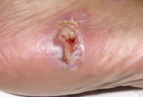 Foot Ulcer