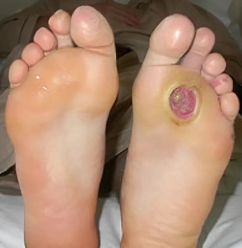 Diabetic Foot Ulcer
