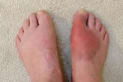 Gout