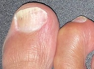 mild nail fungus