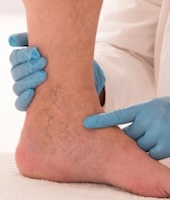 Treating Venous Wound